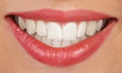 Aligners