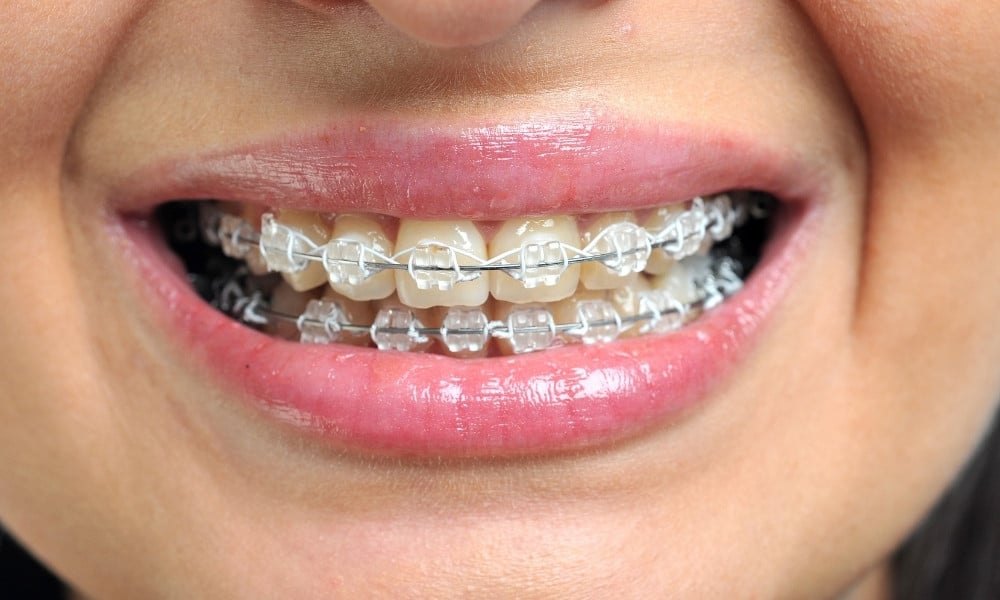 Ceramic Braces