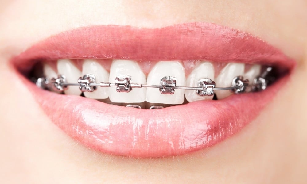 Traditional Braces